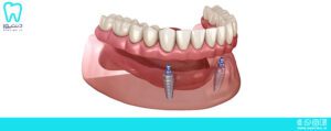 انواع اوردنچر دندانپزشکی